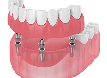  3D model of implant dentures